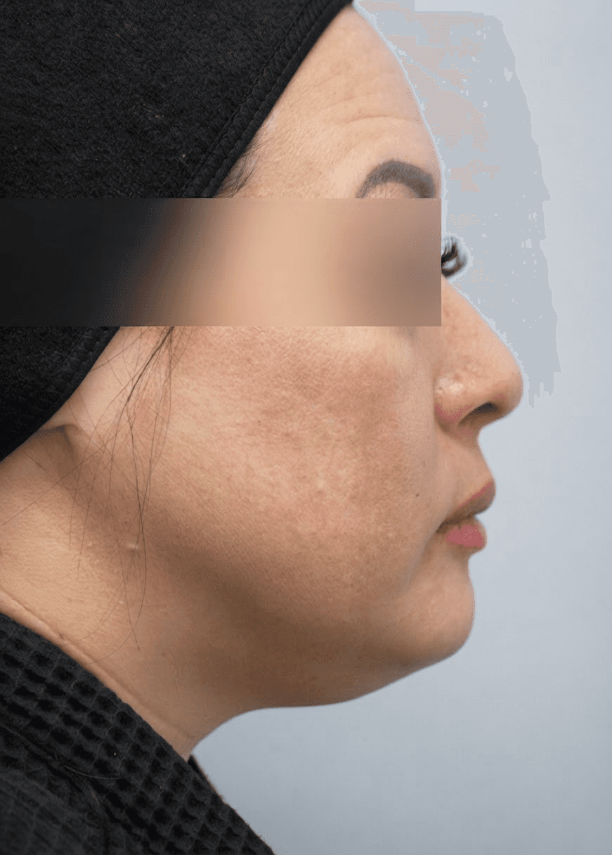 Jawline Contouring patient — before