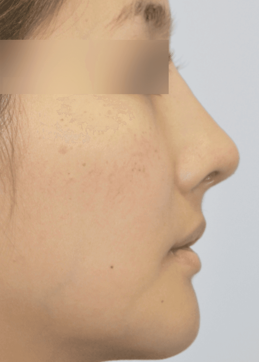 Rhinoplasty before and after in NYC — after